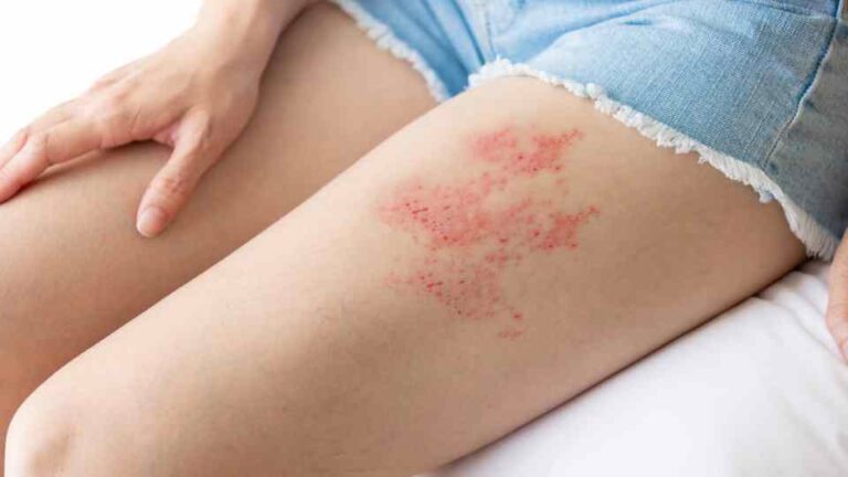 shingles treatment leicester