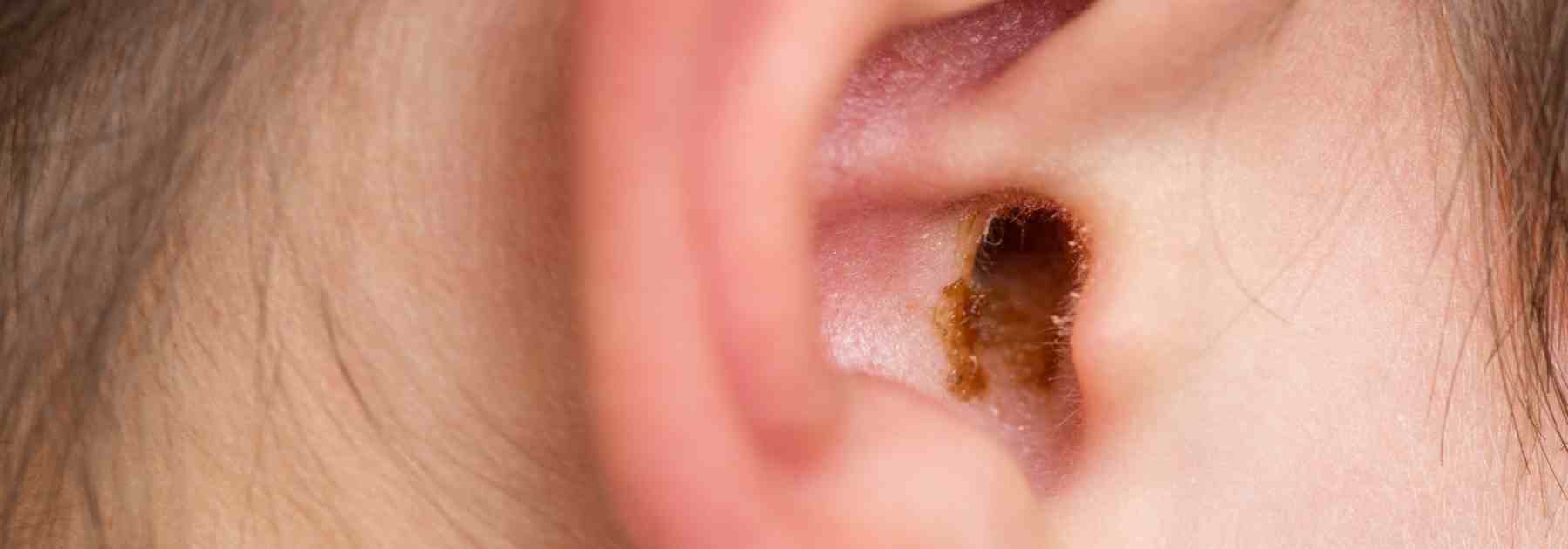 Where can I find earwax removal near me?